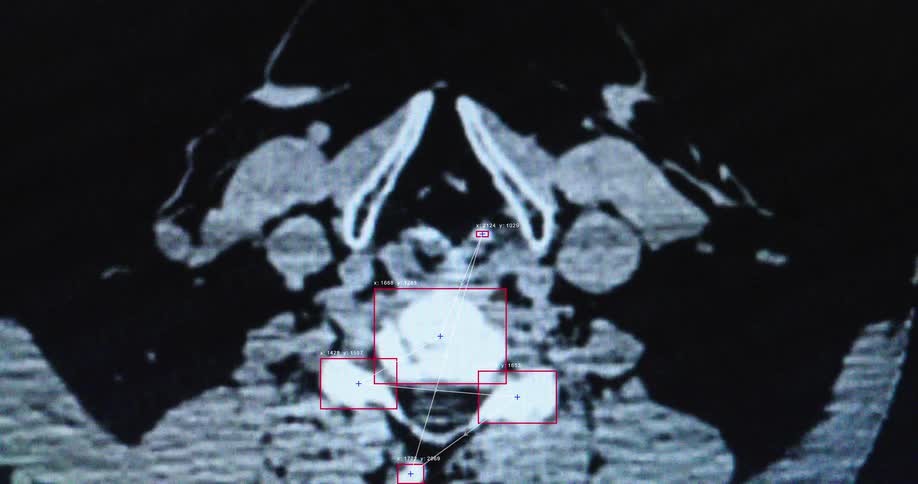Artificial intelligence analyzes a medical CT scan of a human neck, with digital overlays tracking anatomical points for diagnosis