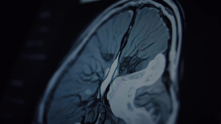 A detailed close-up of a sagittal view of a human brain MRI scan displayed on a monitor
