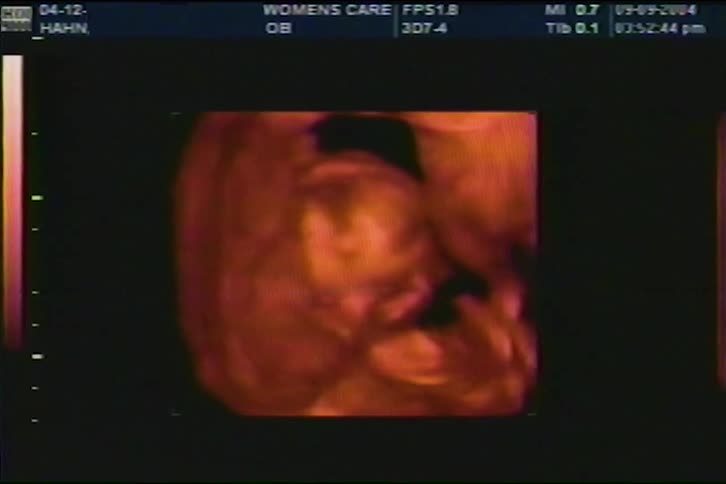 3D and 2D prenatal ultrasound scan showing a fetus during an obstetric examination