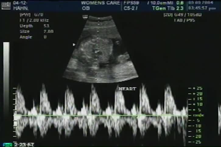 A medical ultrasound screen displays a fetal heart scan with a real-time Doppler graph showing the baby's heartbeat