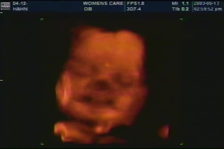 A close-up of a 3D/4D ultrasound showing the detailed face of an unborn baby in the womb