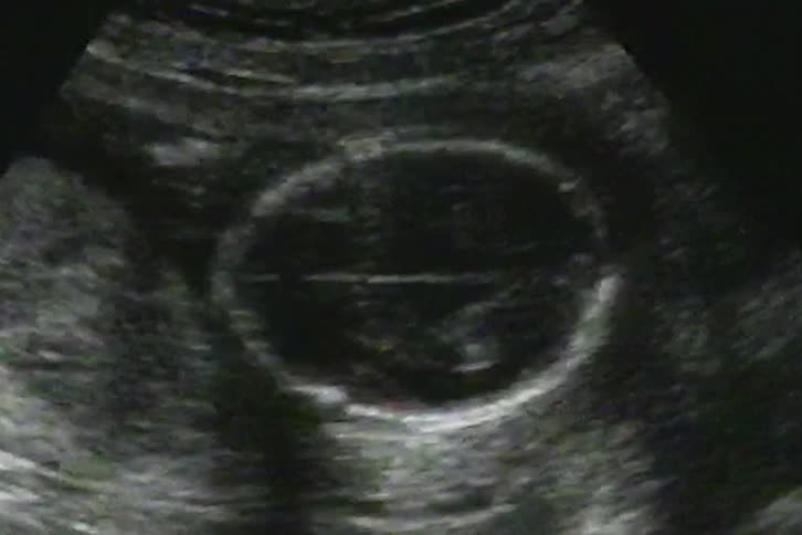 A fetal head is measured for circumference and diameter during a routine prenatal ultrasound examination