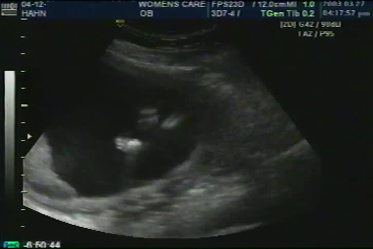 A medical ultrasound scan reveals a developing fetus moving around inside the womb