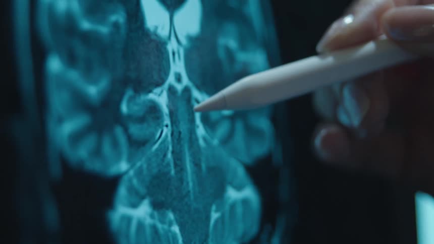 A medical professional uses a digital stylus to trace and analyze a patient's MRI brain scan on a screen