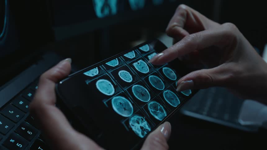A medical professional zooms in to closely examine a patient's brain CT scan on a smartphone in a dark office