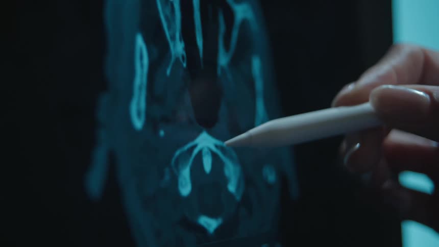 Extreme close-up of a medical professional pointing at a digital skull CT scan with a stylus