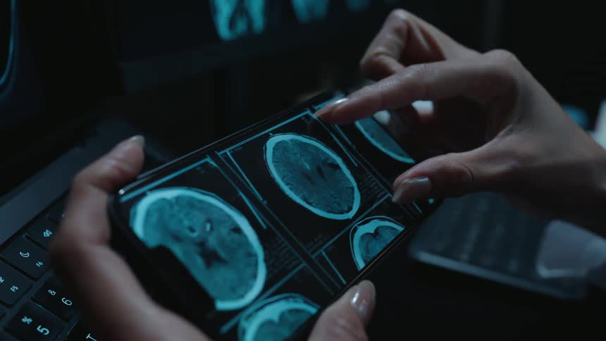 A medical professional's hands zoom in on a digital brain scan displayed on a smartphone screen in a dark room