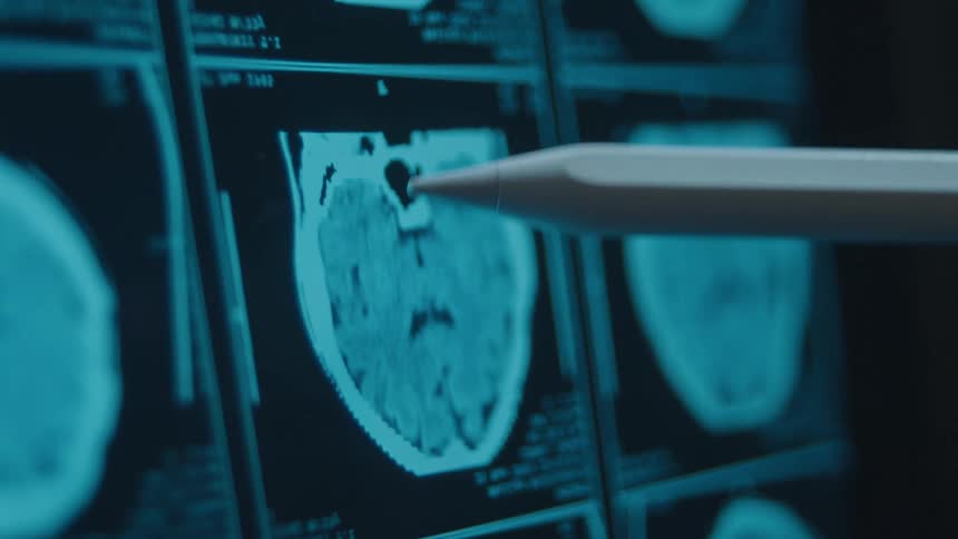 A medical professional uses a digital pen to analyze a patient's brain scan on a screen