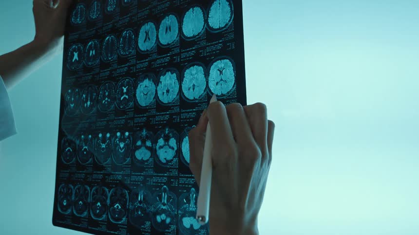 A female doctor closely examines a patient's brain scan, pointing out details on the film against a bright light