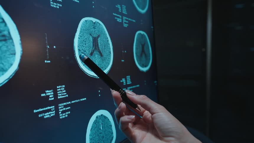 A doctor carefully examines a patient's CT brain scan displayed on a large digital monitor in a modern clinic