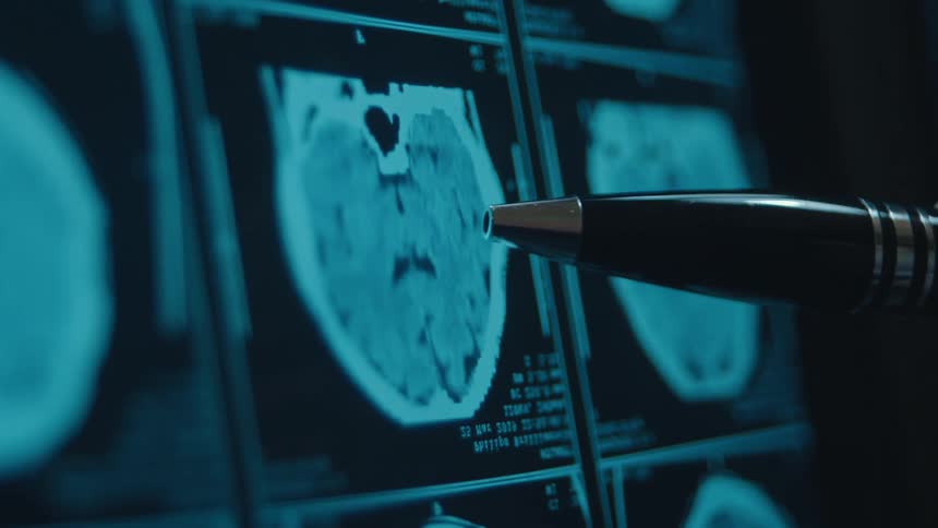 A doctor points with a pen at a CT scan of a human brain on a computer monitor in a dark room