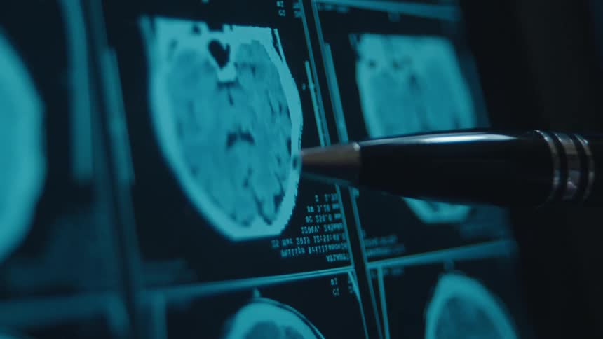 A medical professional carefully analyzes a patient's CT brain scan on a screen, pointing to a specific area with a pen