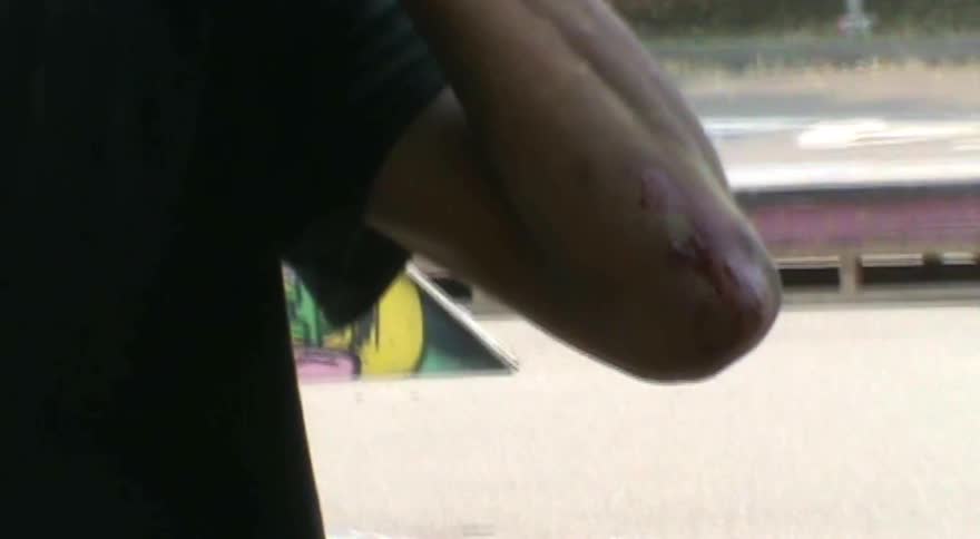 A close-up shot of a skateboarder's scraped and bleeding elbow after a fall in a rain-soaked skatepark