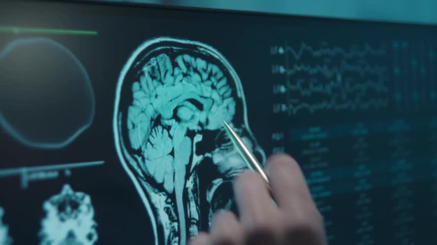 A close-up shot shows a medical professional pointing to areas of a human brain on an MRI scan displayed on a monitor