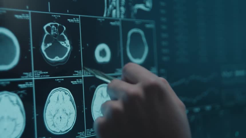 A close-up view of a doctor's hand using a pen to analyze and diagnose a patient's brain CT and MRI scans on a digital screen