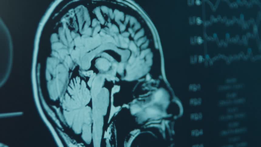 A doctor points to different areas of a human brain MRI scan with a pen while studying the results on a screen