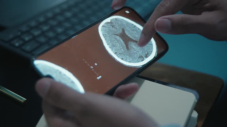 A doctor analyzes a patient's CT brain scan on a smartphone, zooming in to examine the details