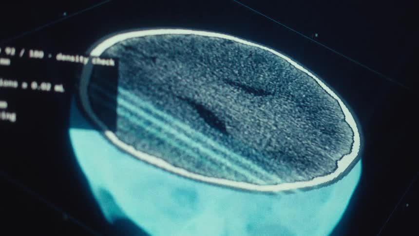 Detailed CT scan of a human brain being analyzed slice by slice on a medical computer monitor