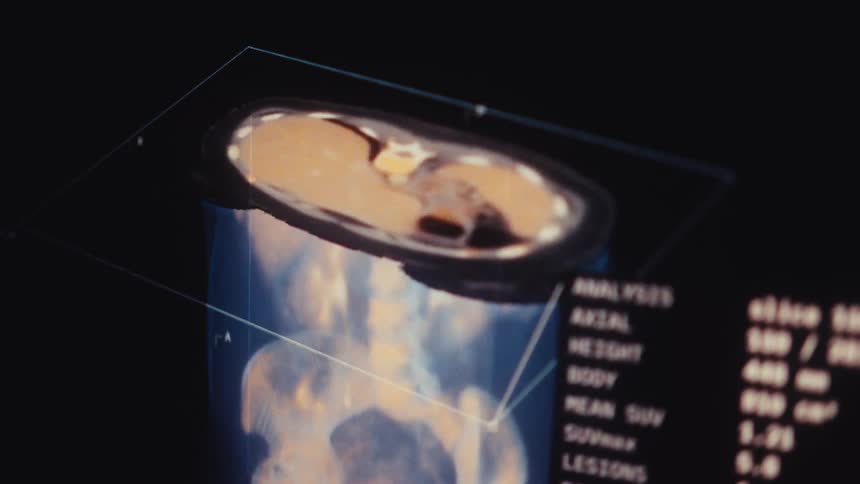 Advanced medical software performs a detailed full-body PET-CT scan, identifying and analyzing lesions on a futuristic user interface