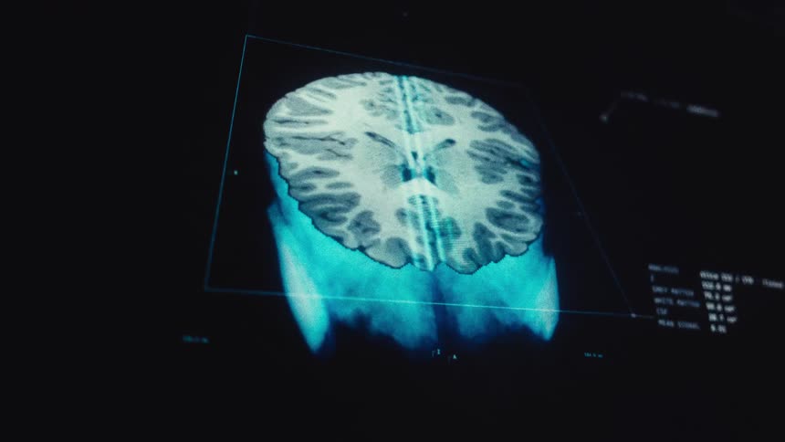 A detailed digital MRI scan progressively revealing the intricate structure of a human brain with corresponding medical analysis data on screen