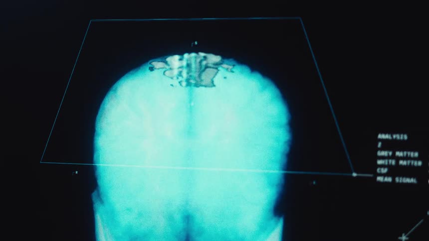 A close-up of a futuristic medical display showing a 3D animated MRI scan of a human brain being analyzed with corresponding data