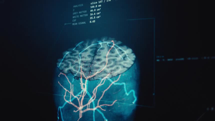 Advanced medical software builds a digital 3D model of the human brain from an MRI scan, highlighting the complex vascular network