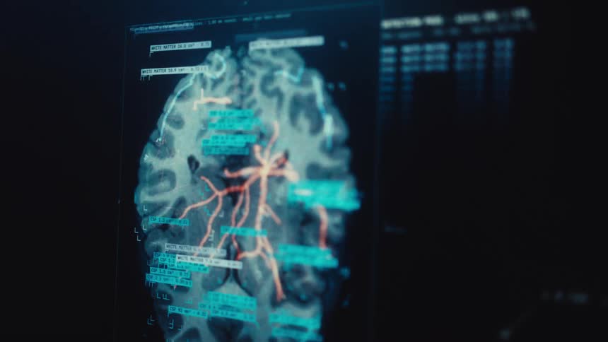 Advanced medical software performs a detailed digital analysis of a human brain, highlighting the complex network of blood vessels