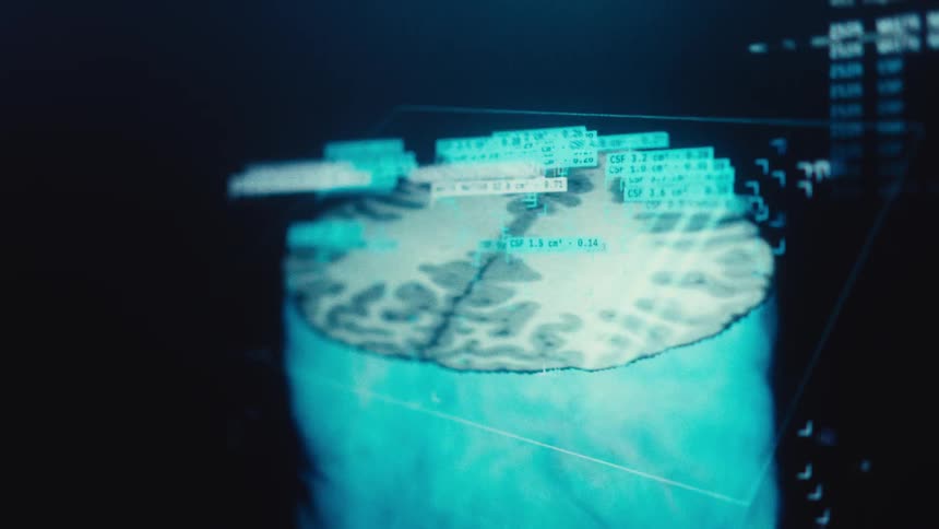 A futuristic medical interface displays a detailed digital analysis of a human brain MRI scan on a screen