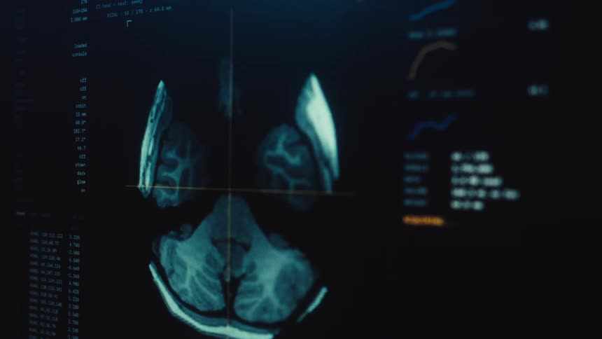 Advanced medical software processes a detailed CT scan of a human brain on a dark digital display with data and graphs
