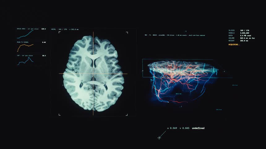 Futuristic medical interface performs a high-tech scan of a human brain, visualizing its complex vascular system