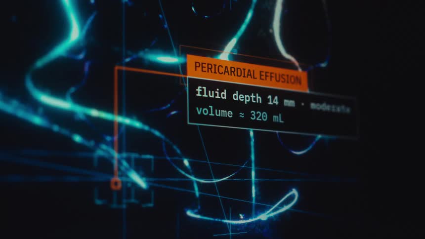 A futuristic medical interface scans abstract data to provide a diagnosis of pericardial effusion