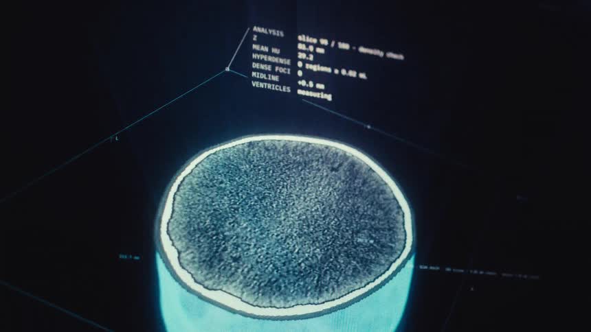 A detailed CT scan showing axial slices of a human head, moving from the skull base through the brain, displayed on a computer monitor with analysis data