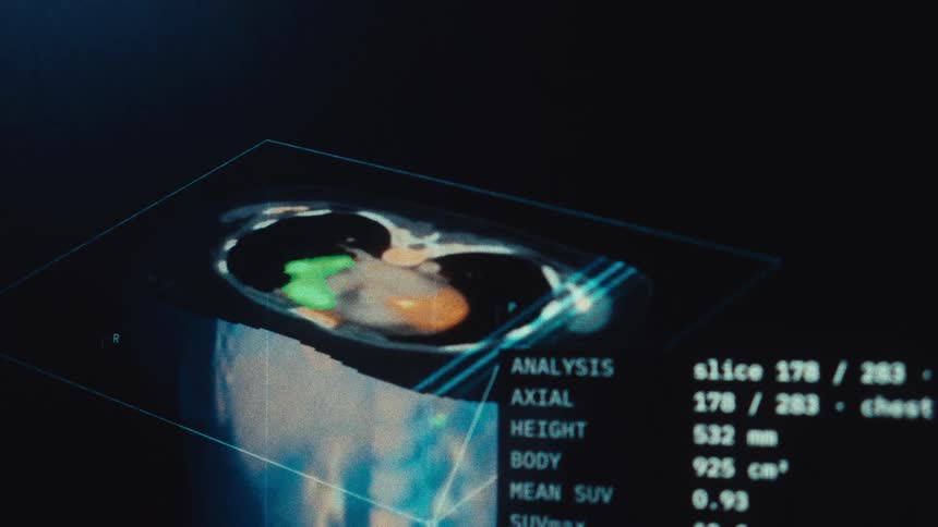A high-tech medical interface displays a detailed, automated full-body scan, analyzing and highlighting cancerous lesions throughout the torso