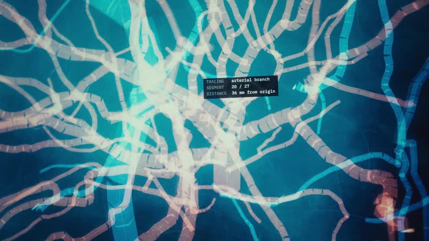 A futuristic sci-fi animation shows a high-tech medical scan tracing arteries in the brain and identifying a suspected thrombus
