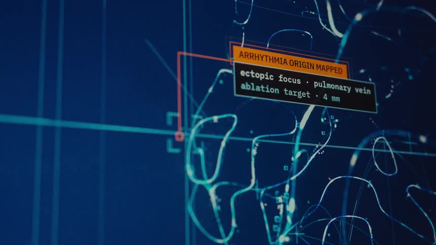 Advanced medical software maps the origin of an arrhythmia on a detailed 3D digital model of a human heart
