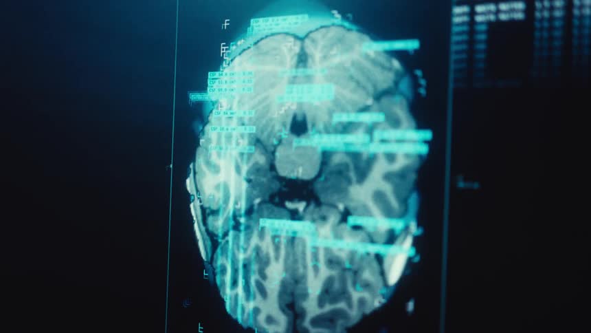 An advanced computer program analyzes a detailed digital scan of a human brain on a monitor