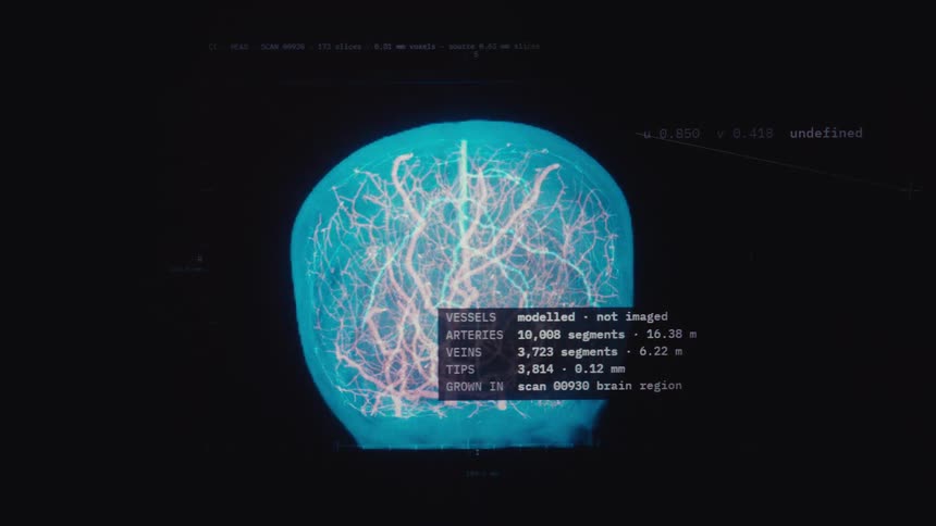 A futuristic digital scan of a human brain shows the intricate network of blood vessels with glitchy visual effects