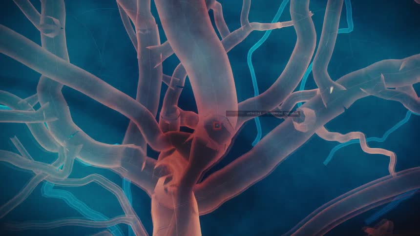 A futuristic medical interface performs a diagnostic scan of human blood vessels, zooming in to detect an arterial occlusion or thrombus