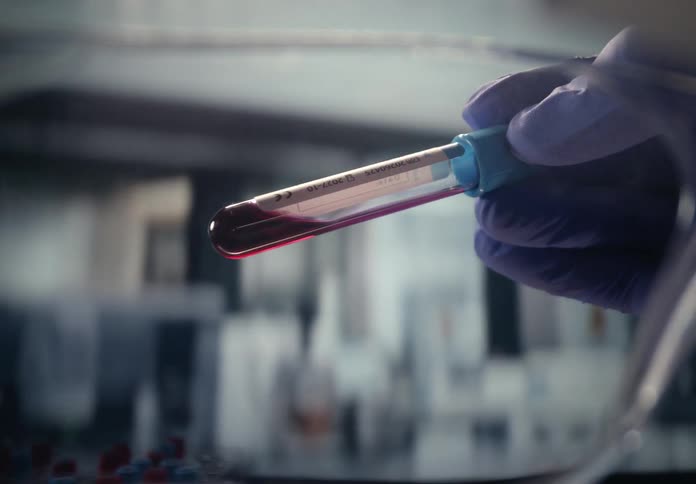 A gloved hand holds a blood sample vial in a clinical laboratory with analysis equipment running in the background