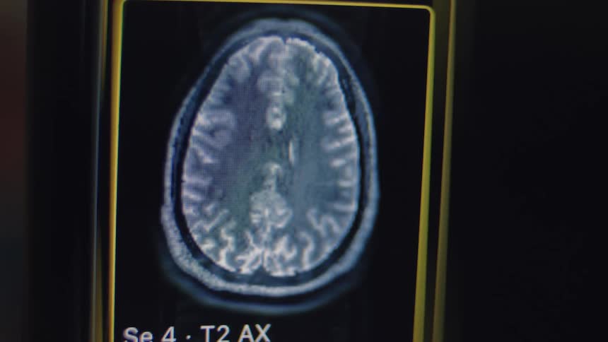 A detailed close-up of a human brain MRI scan being analyzed on a digital monitor