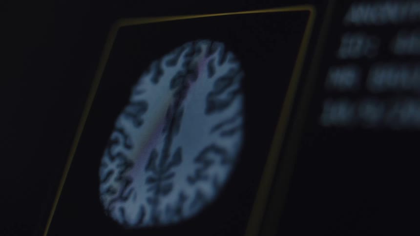 A close-up of a human brain scan on a medical monitor in a dimly lit room