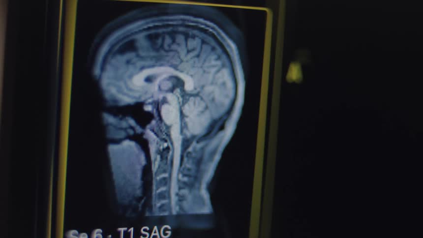 A close-up shot of a monitor displaying a sagittal view of a human brain from an MRI scan