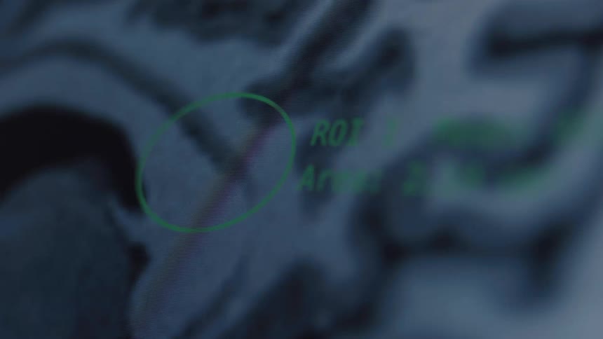A close-up, out-of-focus shot of a computer screen displaying a brain MRI scan with a highlighted region of interest under analysis