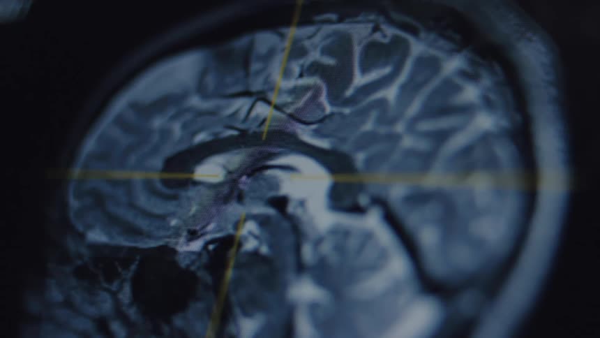 A close-up view of a sagittal MRI brain scan with animated crosshairs moving across the medical imaging data