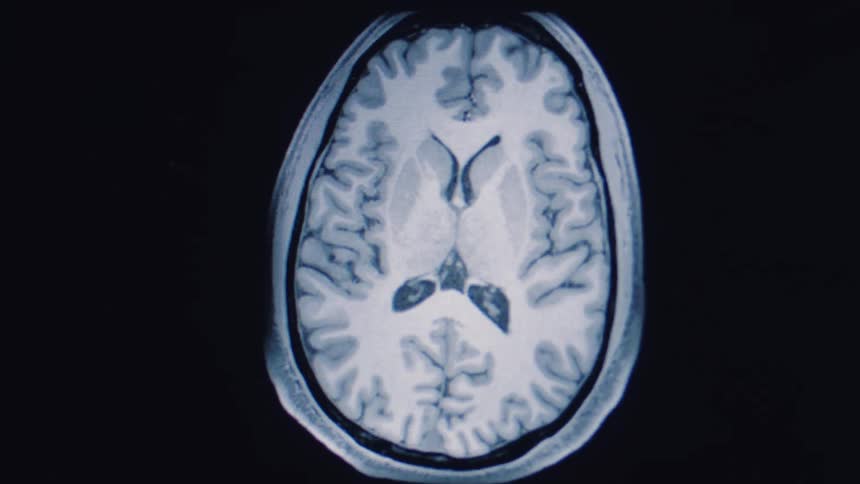 An animated MRI scan reveals the intricate layers and cross-sections of a human brain on a dark background