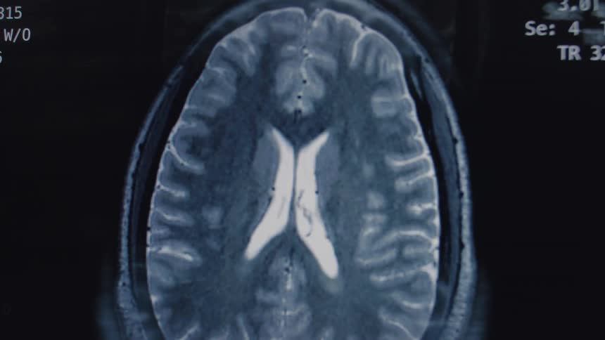 A detailed MRI scan progresses through the cross-sections of a human brain, revealing its complex structures