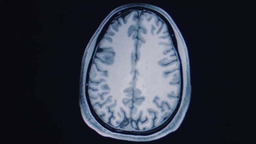 A detailed MRI scan of a human brain zooms out, revealing the intricate layers and structure of the organ