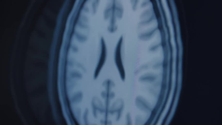 An animated, out-of-focus MRI scan of a human brain slowly comes into focus, revealing its intricate layers