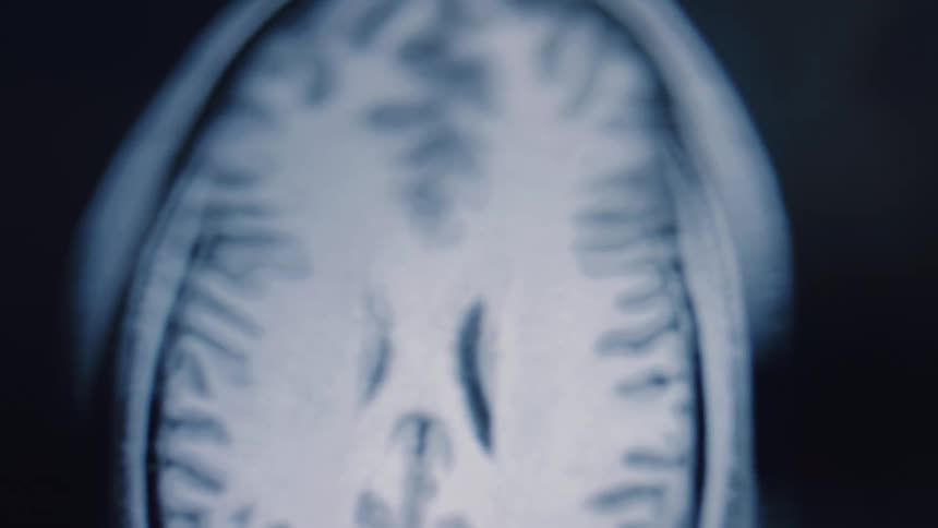 A close-up view of a medical MRI scan animating through the layers of a human brain
