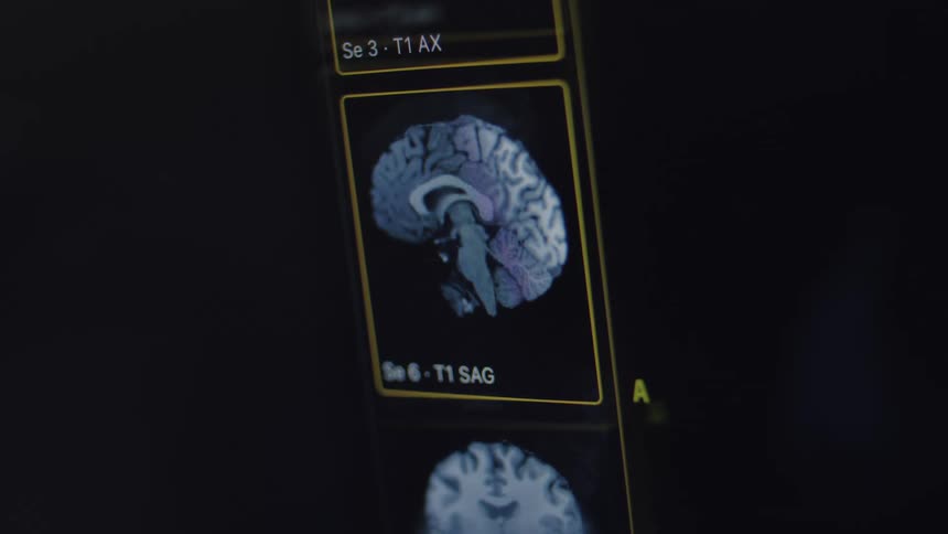 Close up of a monitor displaying detailed MRI scans of a human brain